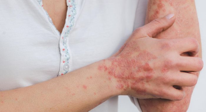 ASUGI, 11 marzo: negli ospedali con il bollino rosa consulenze e servizi gratuiti sulla psoriasi